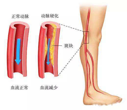 有這三種情況的人，千萬(wàn)不能用熱水泡腳！