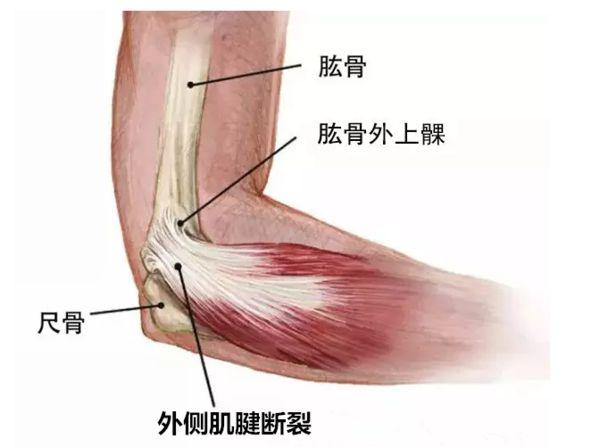 從不打網(wǎng)球的人，為什么也會(huì)得網(wǎng)球肘？這就是原因！