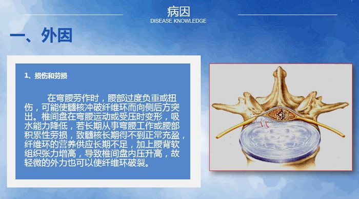 國康健康保險談腰椎間盤突出