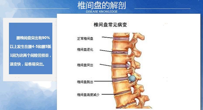 國康健康保險談腰椎間盤突出