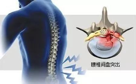 國康健康保險談腰椎間盤突出