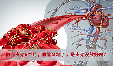 做完支架6個(gè)月，血管又堵了，是支架沒(méi)放好嗎？