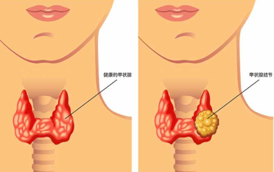 關(guān)于甲狀腺結(jié)節(jié)的那些事，原來飲食也有那么多講究
