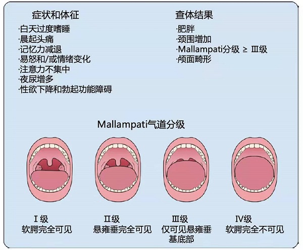 打鼾真的會誘發(fā)心血管疾病嗎？