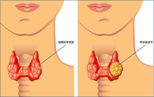體檢查出甲狀腺結(jié)節(jié)應(yīng)該怎么辦？不復(fù)查真的會(huì)癌變嗎？一文講清楚